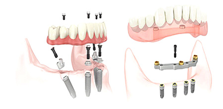 Принцип установки челюсти на 4 импланта