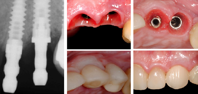 Имплантации под ключ цены на dental-implantology.ru