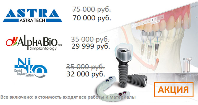 Имплантация под ключ тюмень