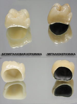 Безметалловая керамика зубов цена