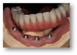 all on 4 implant