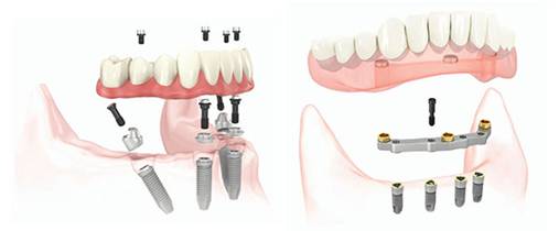 Зубной протез на имплантах: несъемный, условно съемный, с балочным креплением