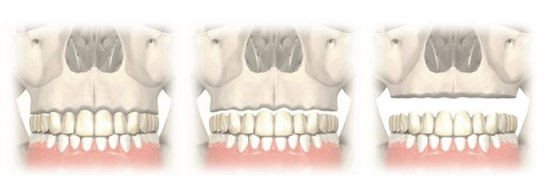 Имплантация зубов верхней челюсти при атрофии костной ткани на dental-implantology.ru