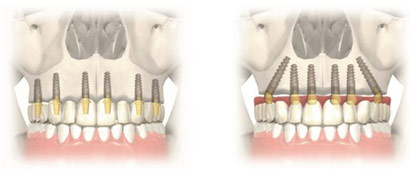 Имплантация верхней челюсти при отсутствии зубов на dental-implantology.ru