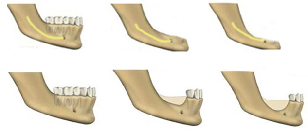 Имплантация зубов нижней челюсти при атрофии костной ткани на dental-implantology.ru