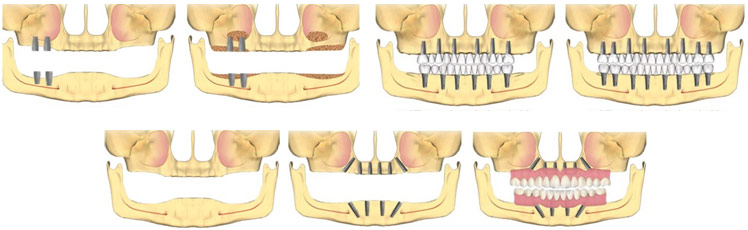 Полная имплантация зубов нижней челюсти на dental-implantology.ru