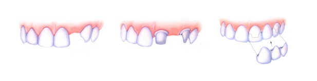 Обточка зубов под мостовидный протез
