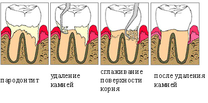 кюретаж пародонтальных карманов