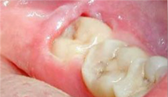 Иссечение капюшона зуба мудрости цена на dental-implantology.ru